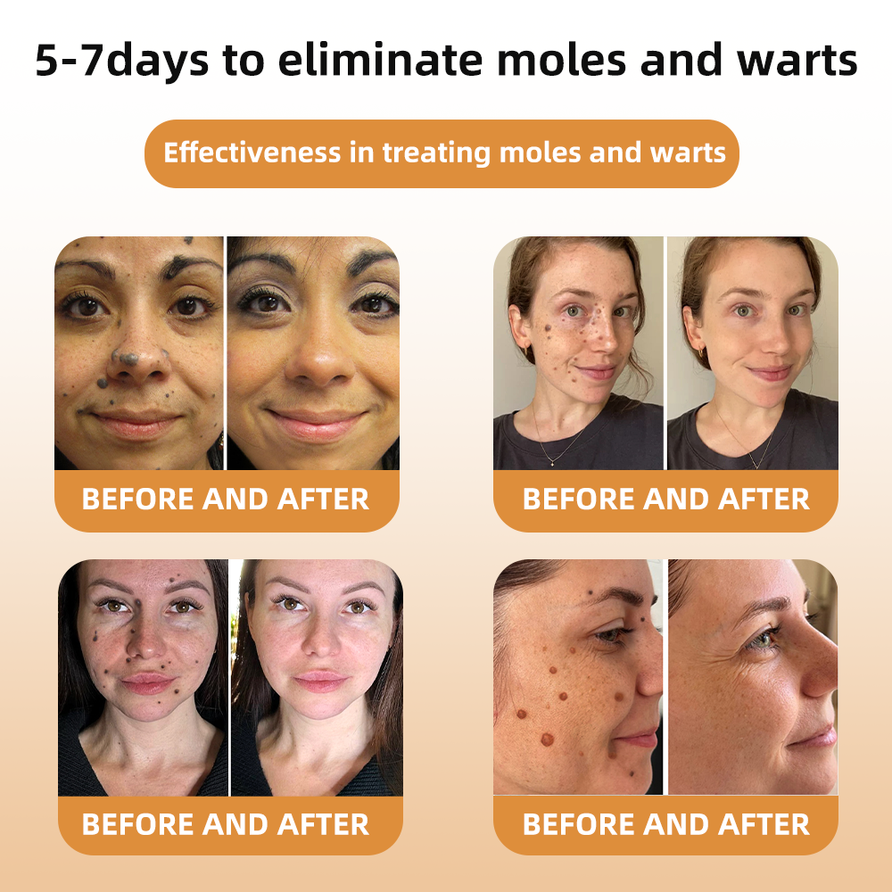 šWREE⢠BEE VENOM Mole and Wart Treatment Cream(šØāāSuitable for all skin types)š(š„Last day promotion 60% off)
