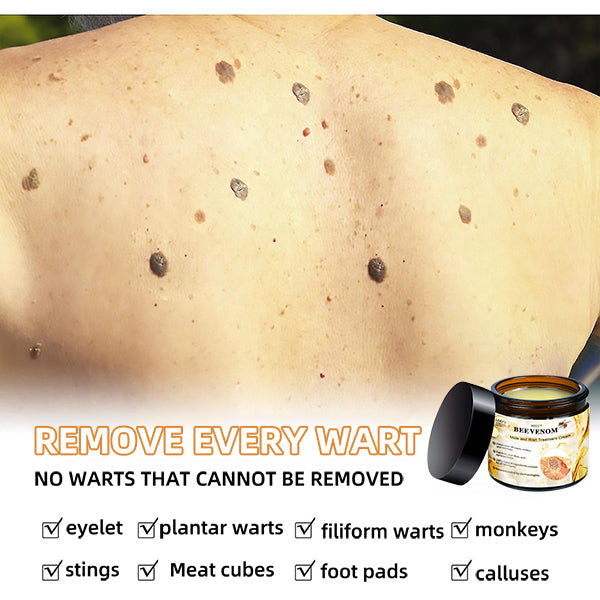 šWREE⢠BEE VENOM Mole and Wart Treatment Cream(šØāāSuitable for all skin types)š(š„Last day promotion 60% off)
