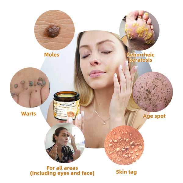 šWREE⢠BEE VENOM Mole and Wart Treatment Cream(šØāāSuitable for all skin types)š(š„Last day promotion 60% off)