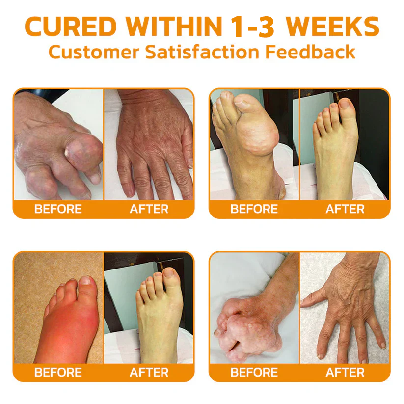 ✅Official Store: Bostore™ Bee-Venom Pain-Relief Bone Healing Cream👨⚕️Orthopaedic Association(AOA) Approved (Reducing joint swelling, pain, stiffness, redness, warmth, soreness, and joint fatigue)